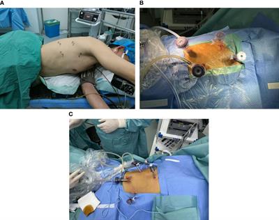 Robotic assisted minimally invasive esophagectomy versus minimally invasive esophagectomy